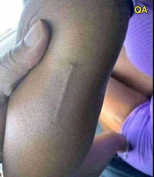 Found This on My Daughter’s Arm — What Could It Be?