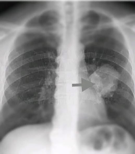 Global Health Alert: Scientists Report a Mysterious New Cancer Type