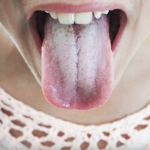 Listen to Your Tongue: 11 Subtle Health Messages It Sends