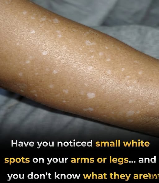What Vitamin Deficiencies May Lead to White Spots on the Skin