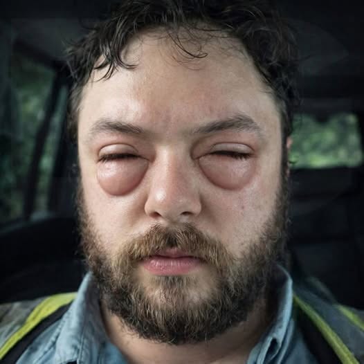 Eye Bumps Explained: Causes, Signs, and When to Get Checked