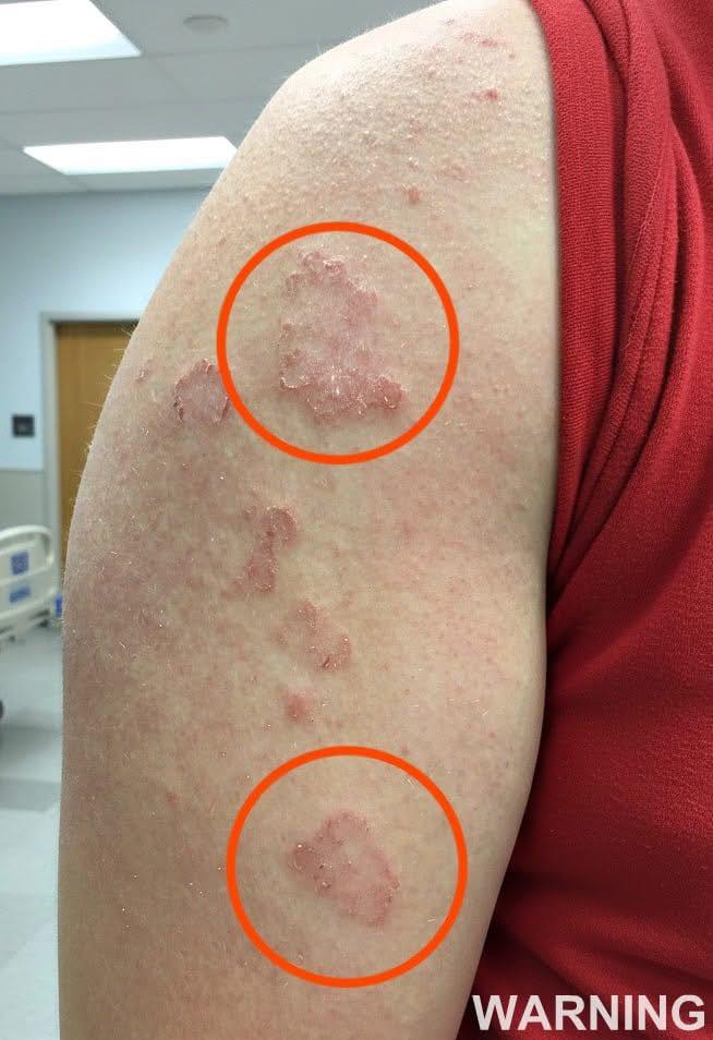 If you notice red marks forming on your arm, it may be a sign of ca…