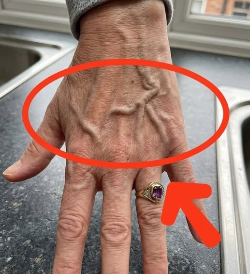 Visible Veins Explained: Common Causes, Possible Health Concerns, and When You Should Pay Attention