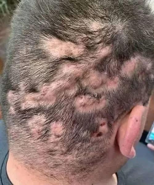 “These are the first symptoms of crabs (pubic lice)… See more”